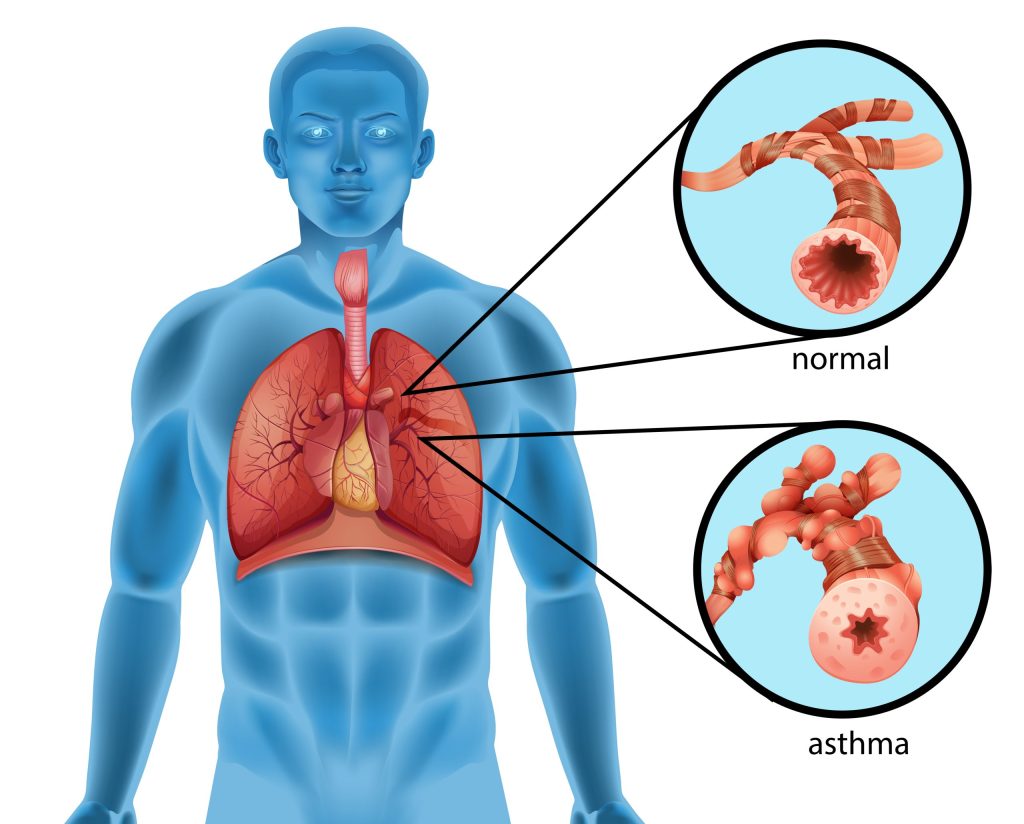 lungs asthma Vs normal lungs
